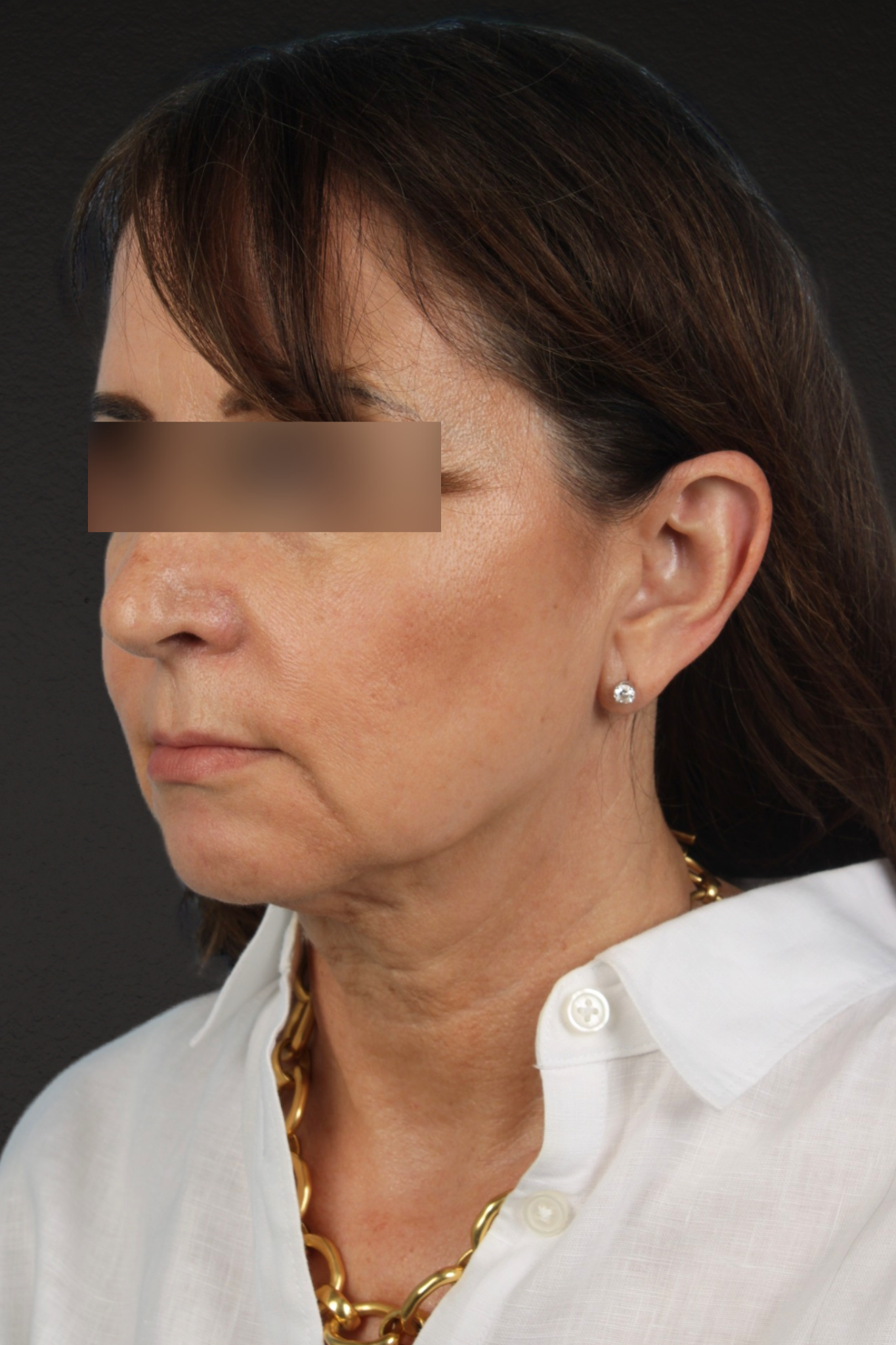 Facelift Before & After Gallery - Patient 407291 - Image 7
