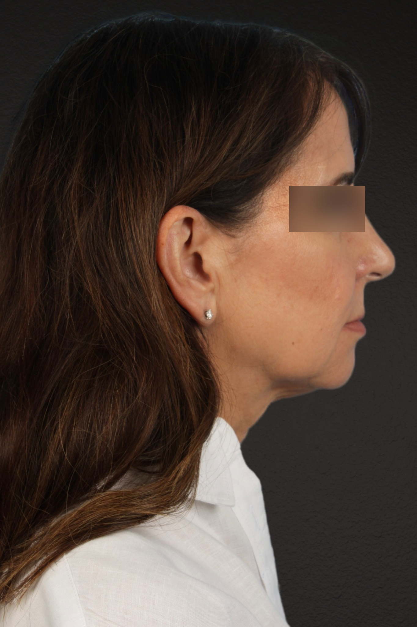 Facelift Before & After Gallery - Patient 407291 - Image 9