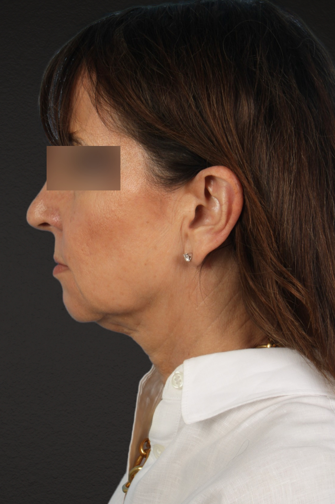 Facelift Before & After Gallery - Patient 407291 - Image 3