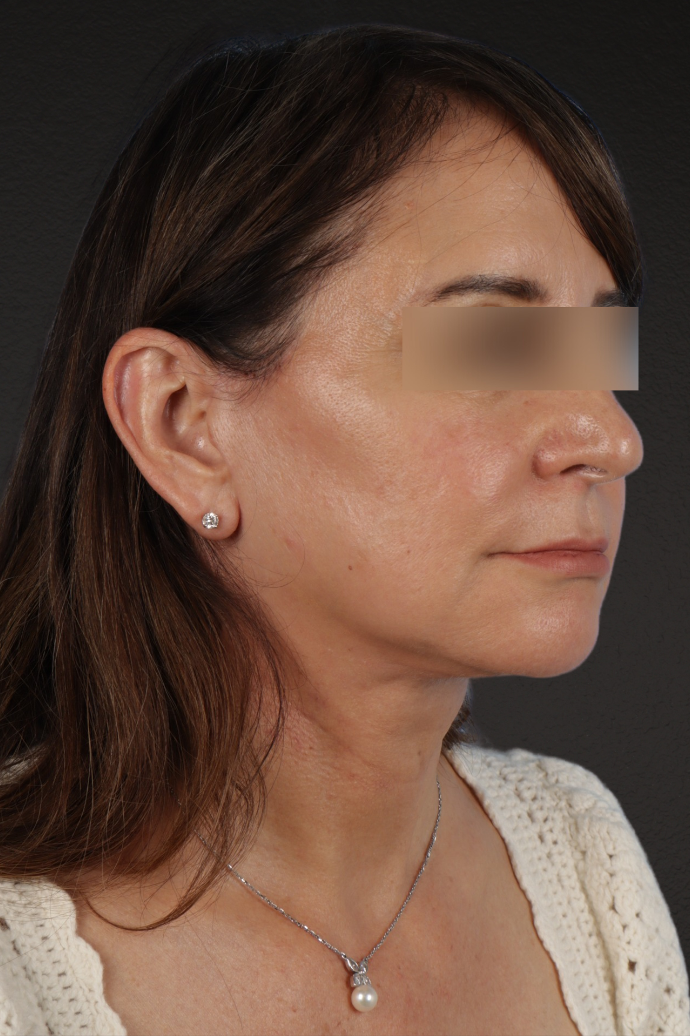 Facelift Before & After Gallery - Patient 407291 - Image 6