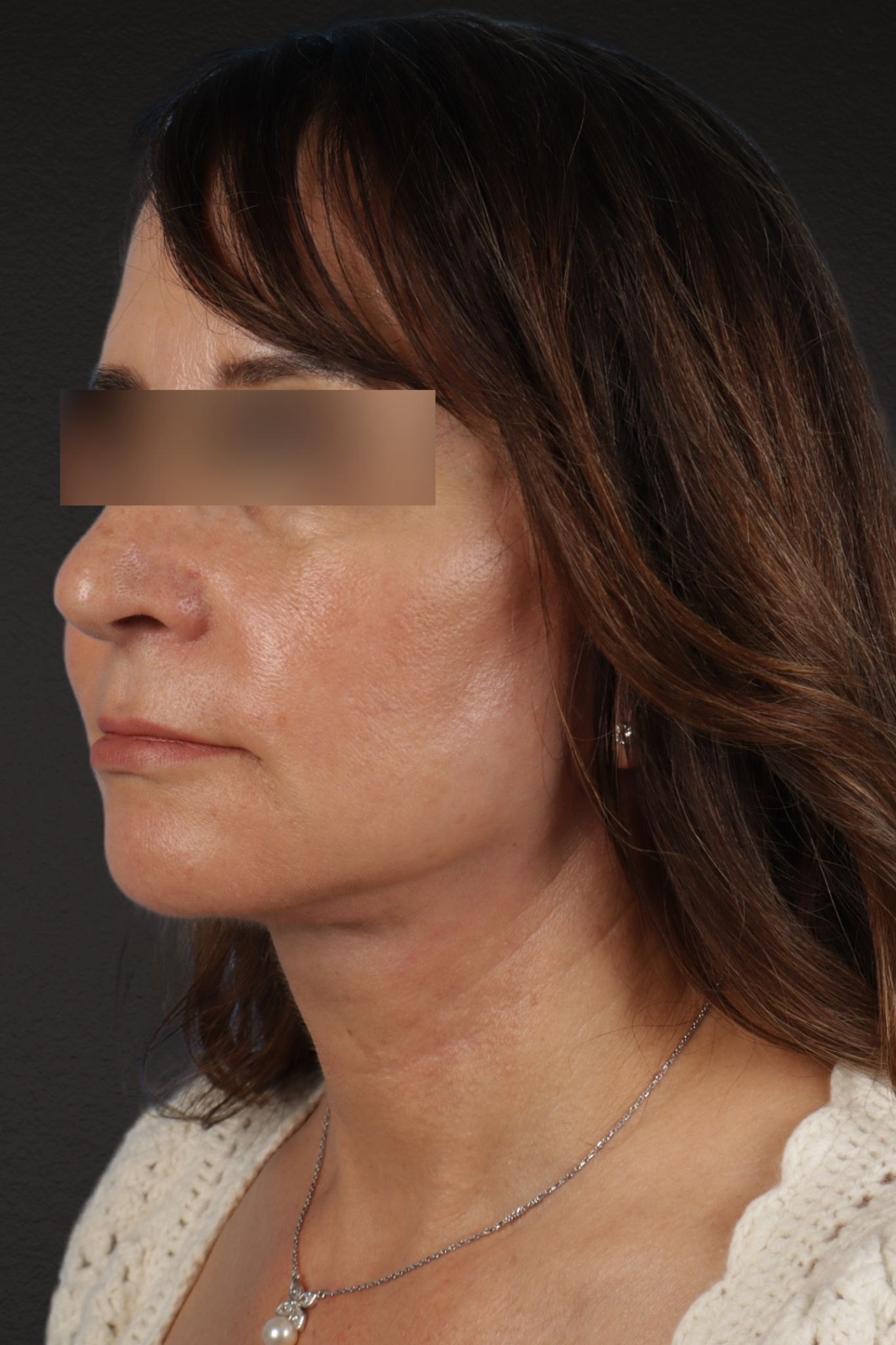 Facelift Before & After Gallery - Patient 407291 - Image 8
