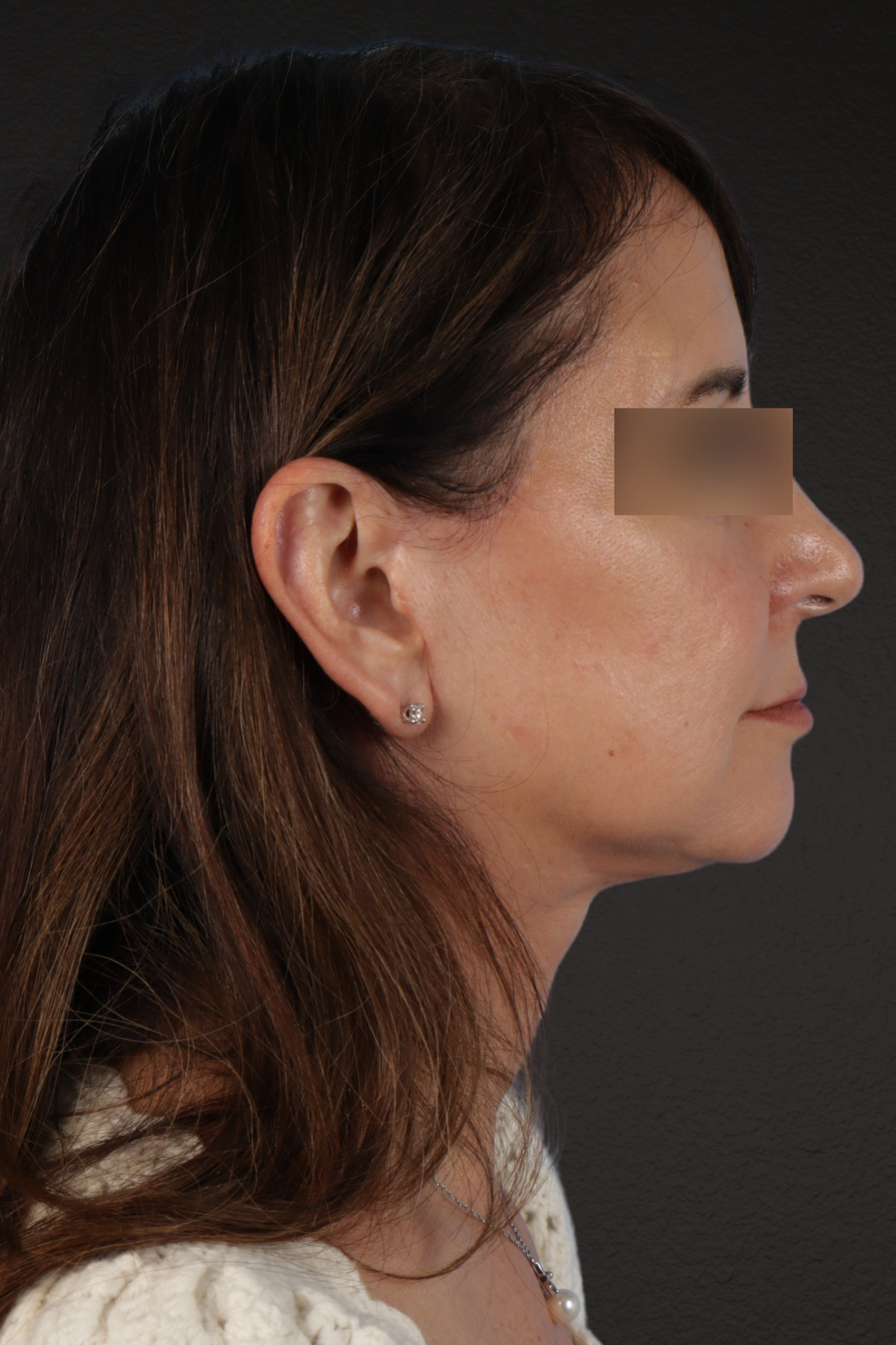 Facelift Before & After Gallery - Patient 407291 - Image 10