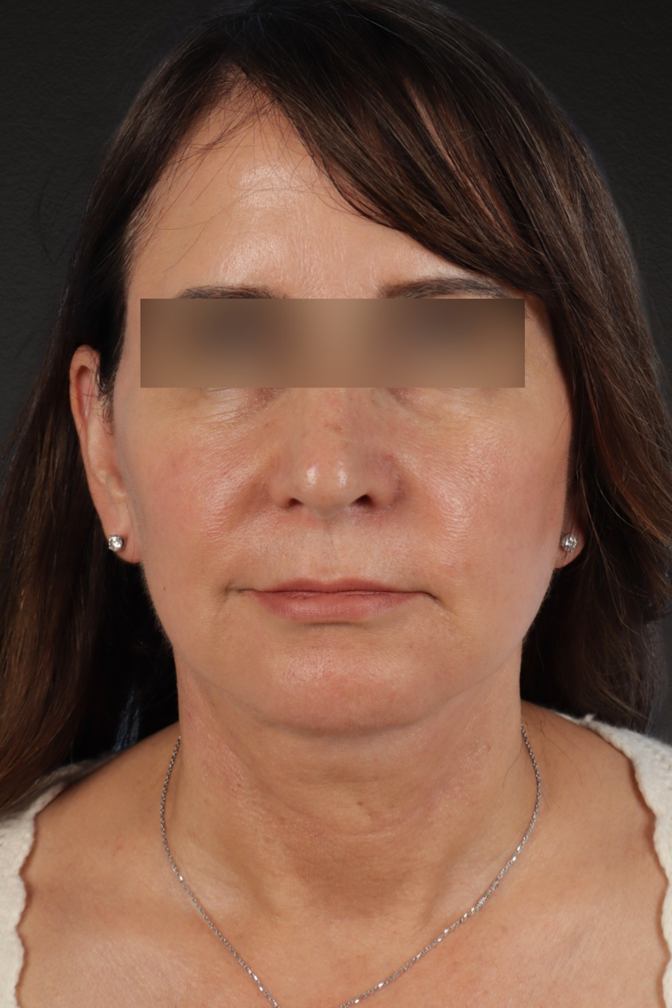 Facelift Before & After Gallery - Patient 407291 - Image 2