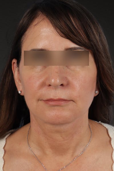 Facelift Before & After Gallery - Patient 407291 - Image 2