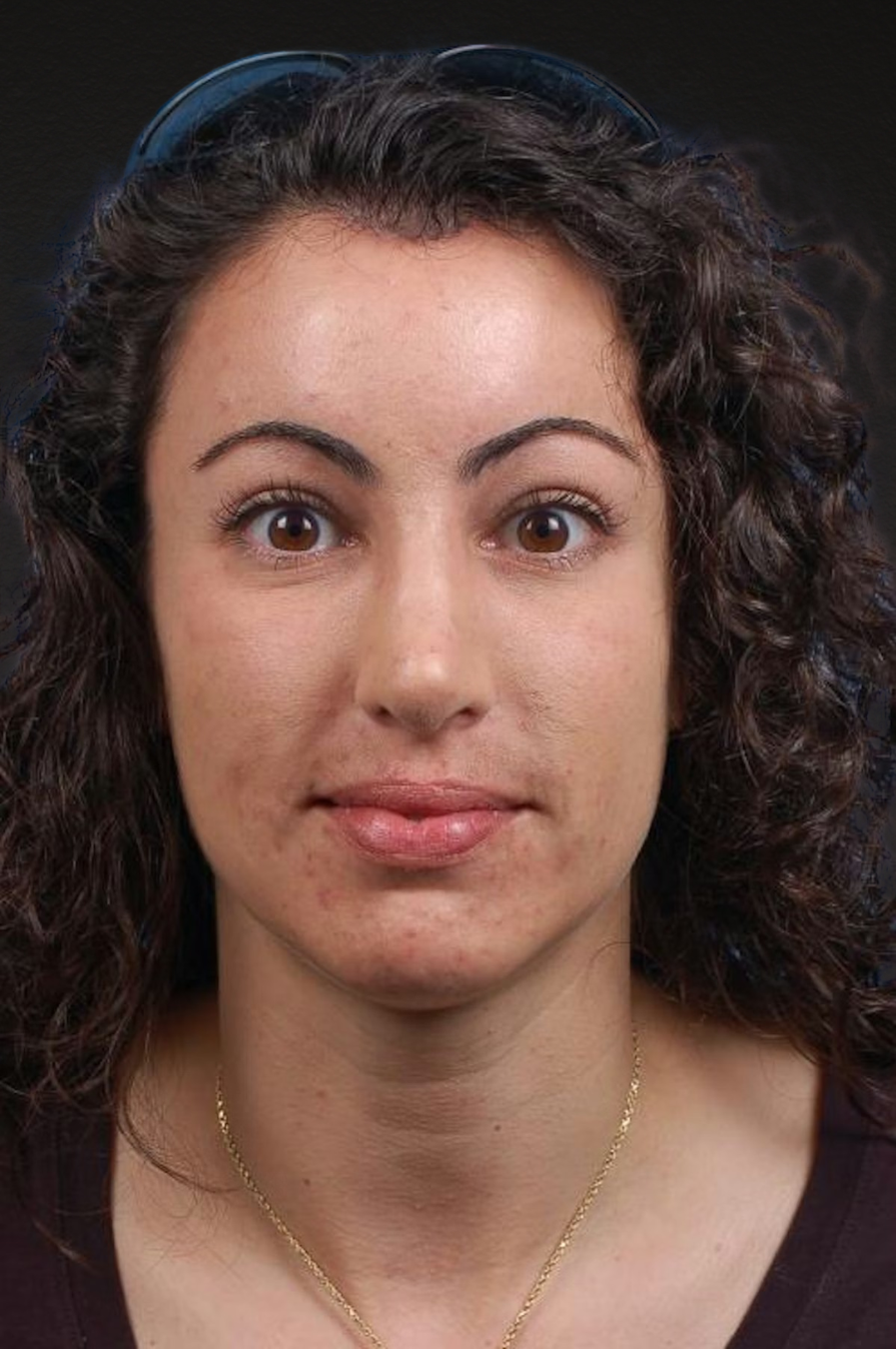 Brow Lift Before & After Gallery - Patient 978632 - Image 2