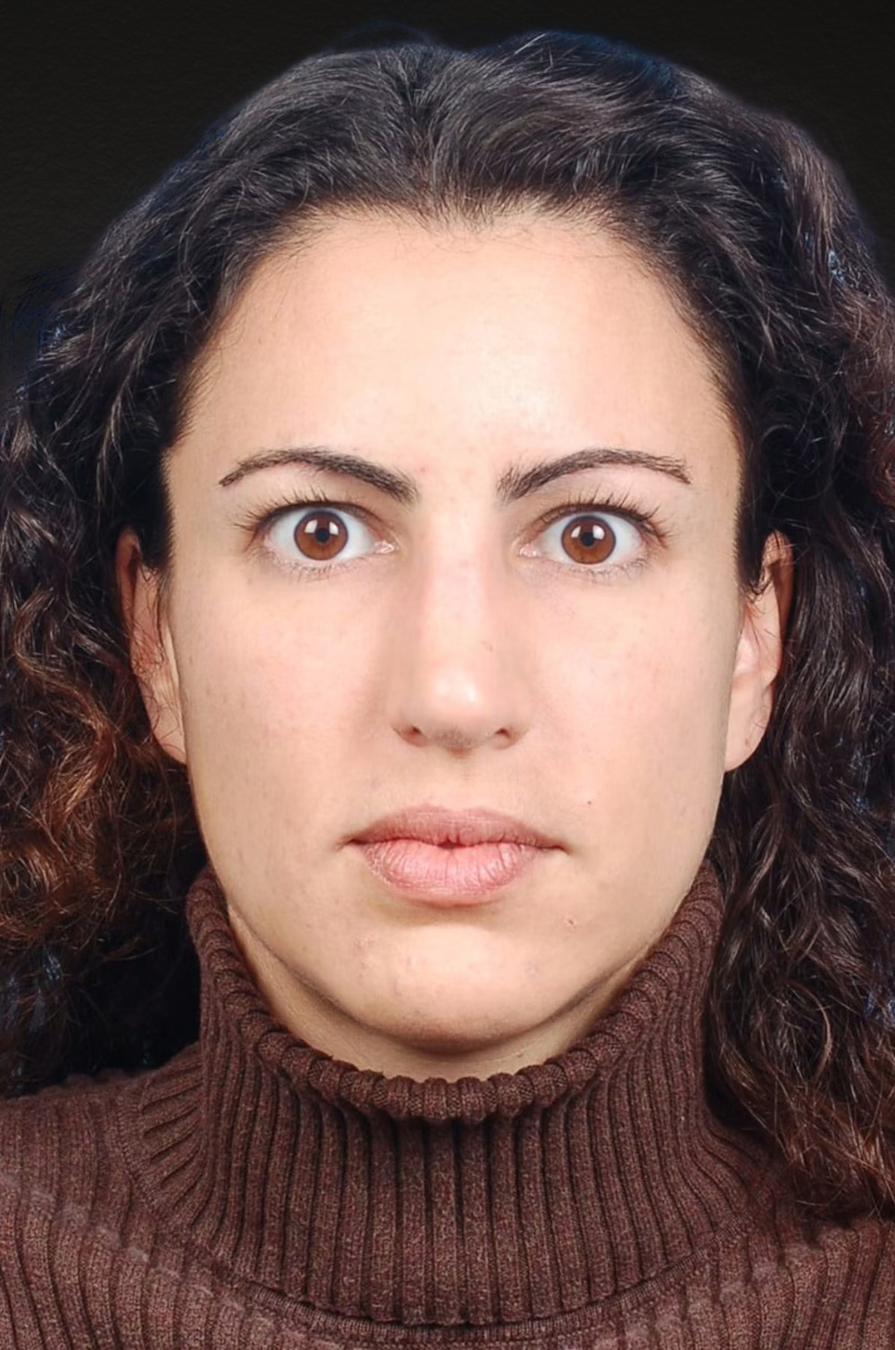 Brow Lift Before & After Gallery - Patient 978632 - Image 1