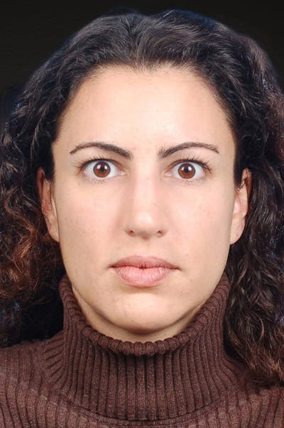 Brow Lift Before & After Gallery - Patient 978632 - Image 1
