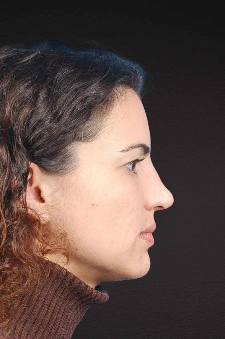 Brow Lift Before & After Gallery - Patient 978632 - Image 3