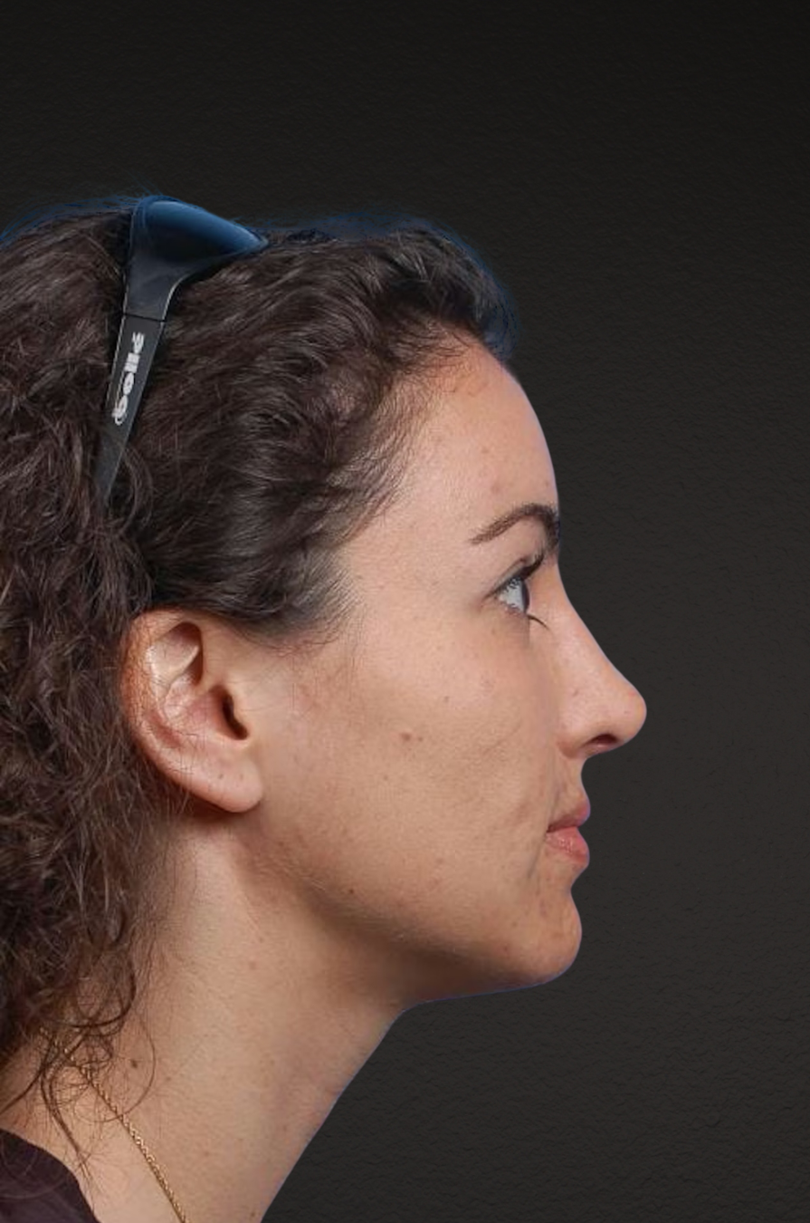 Brow Lift Before & After Gallery - Patient 978632 - Image 4