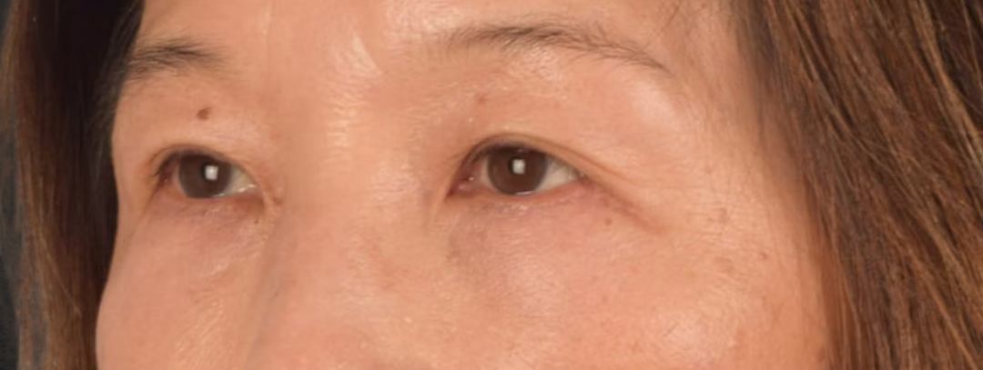 Brow Lift Before & After Gallery - Patient 542005 - Image 6