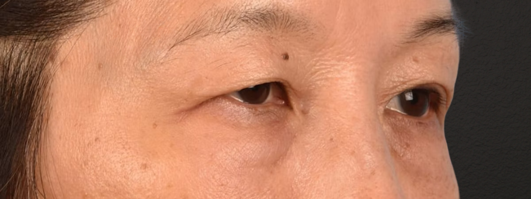 Brow Lift Before & After Gallery - Patient 542005 - Image 3