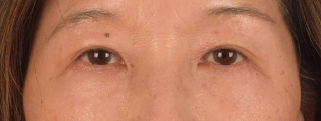 Brow Lift Before & After Gallery - Patient 542005 - Image 2