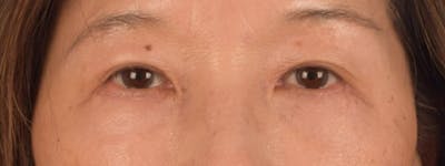 Brow Lift Before & After Gallery - Patient 542005 - Image 2