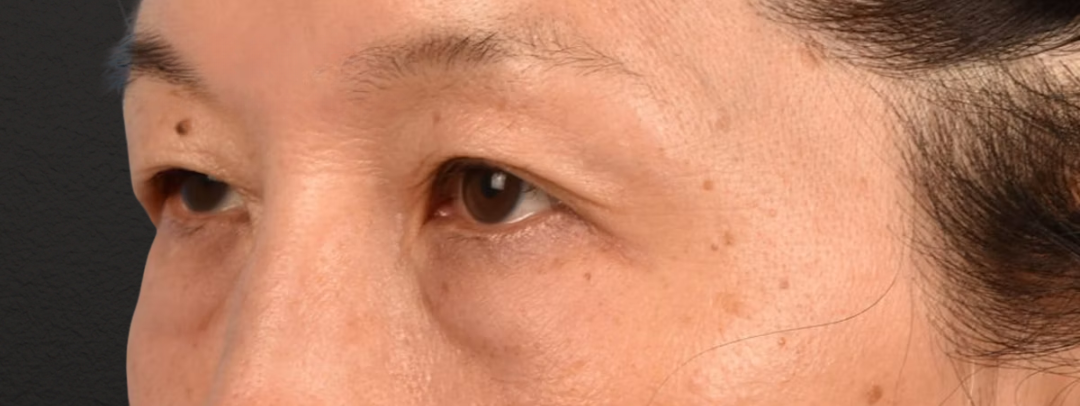 Brow Lift Before & After Gallery - Patient 542005 - Image 5