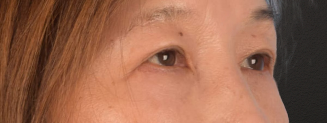 Brow Lift Before & After Gallery - Patient 542005 - Image 4