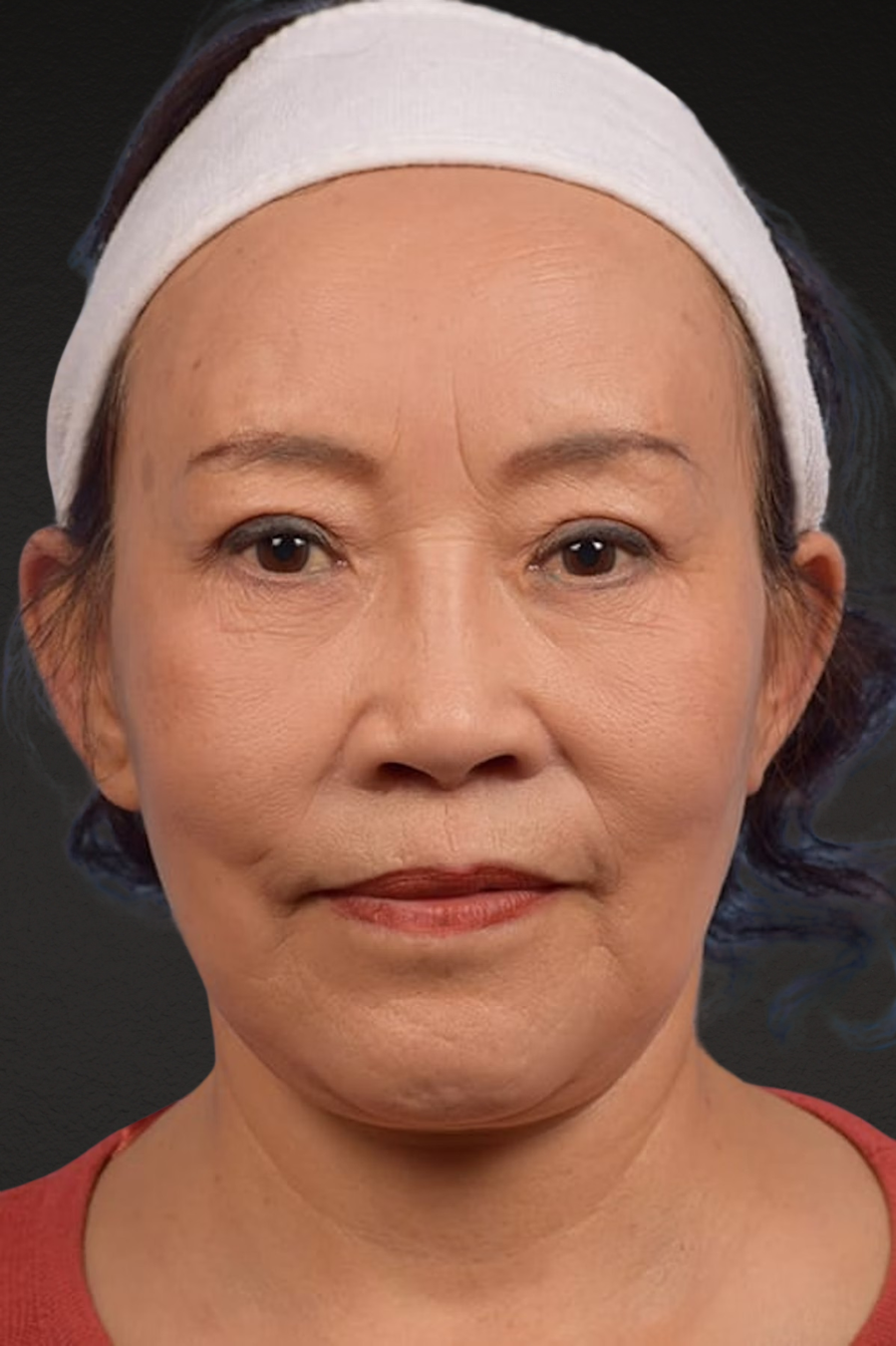 Brow Lift Before & After Gallery - Patient 375961 - Image 2