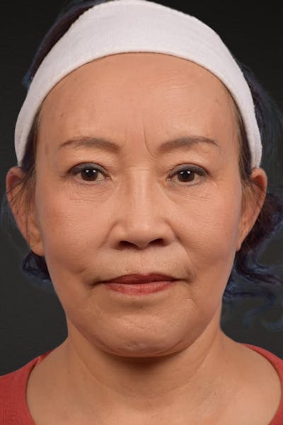 Brow Lift Before & After Gallery - Patient 375961 - Image 2