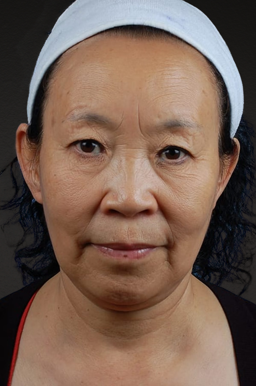 Brow Lift Before & After Gallery - Patient 375961 - Image 1