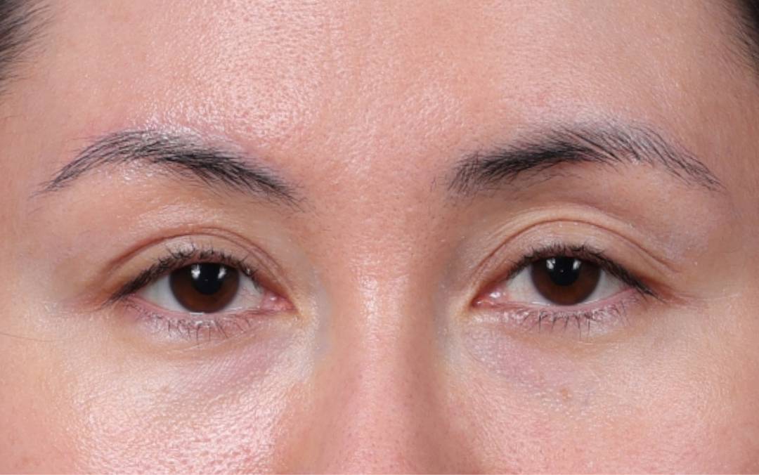 Brow Lift Before & After Gallery - Patient 324298 - Image 2