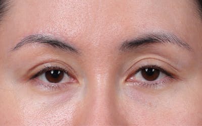 Blepharoplasty Before & After Gallery - Patient 751991 - Image 2