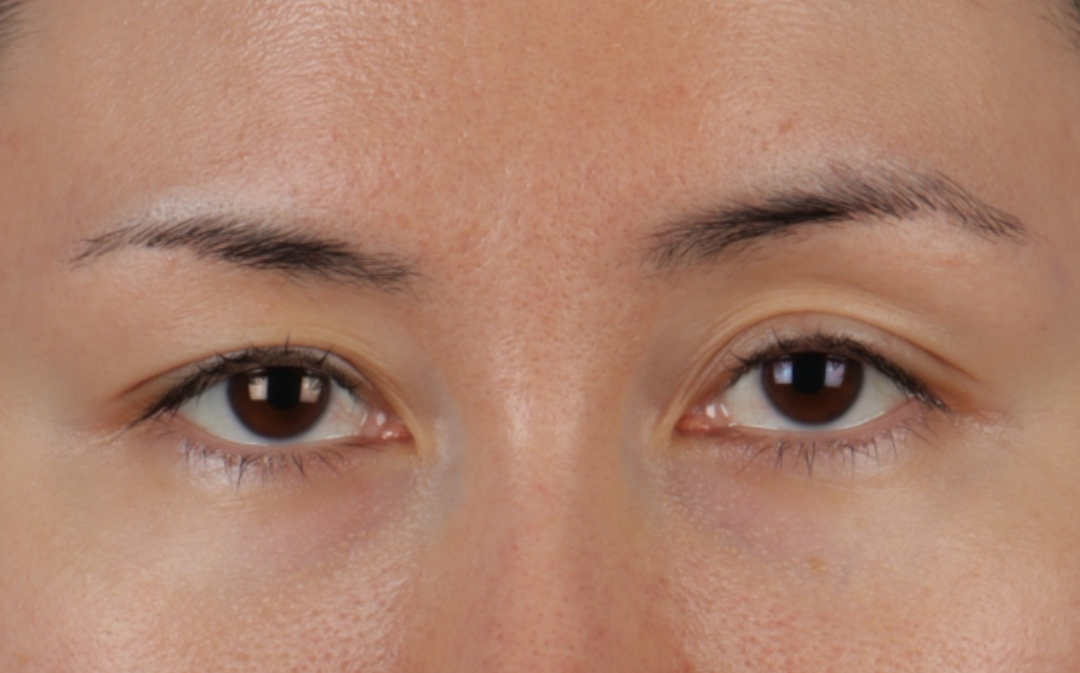 Brow Lift Before & After Gallery - Patient 324298 - Image 1
