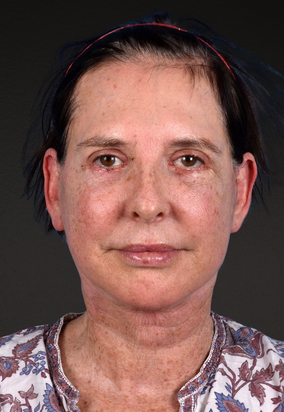 Brow Lift Before & After Gallery - Patient 488051 - Image 2