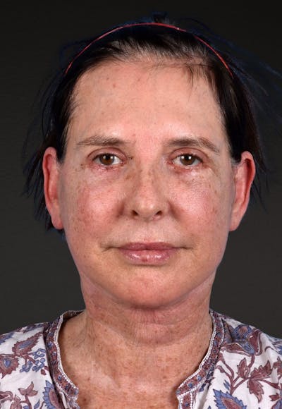 Brow Lift Before & After Gallery - Patient 488051 - Image 2