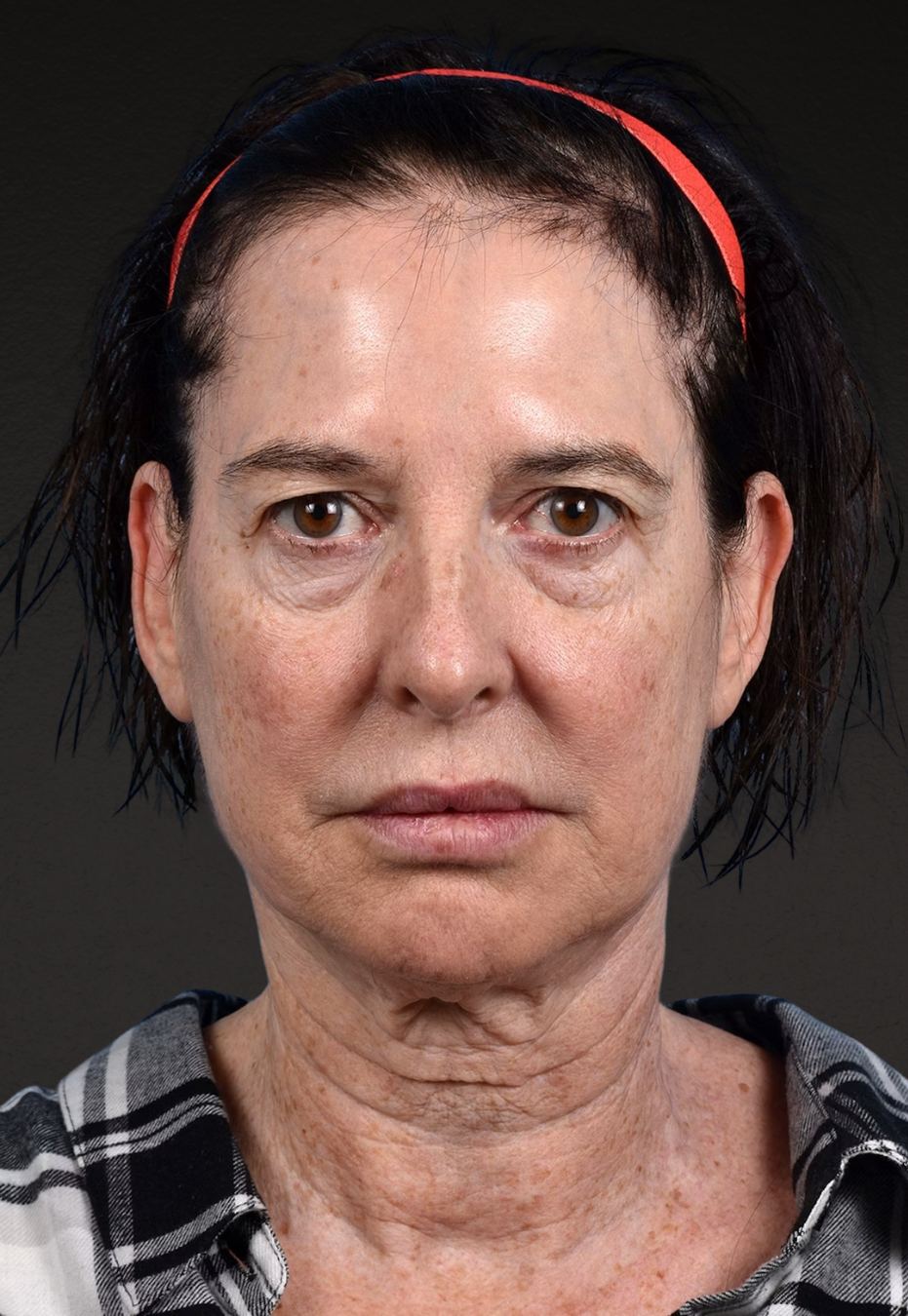 Brow Lift Before & After Gallery - Patient 488051 - Image 1