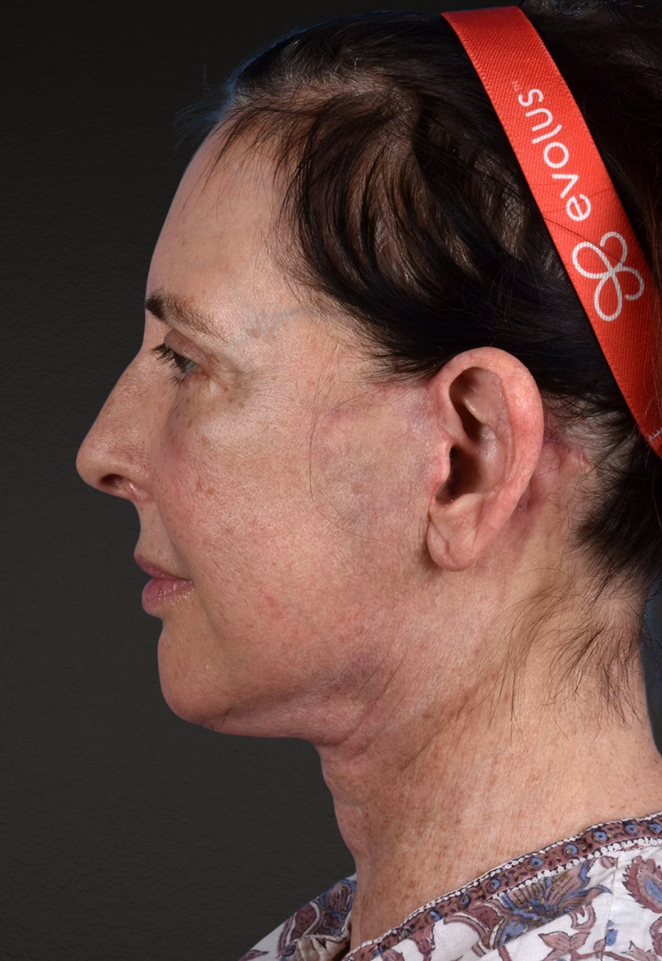 Brow Lift Before & After Gallery - Patient 488051 - Image 8