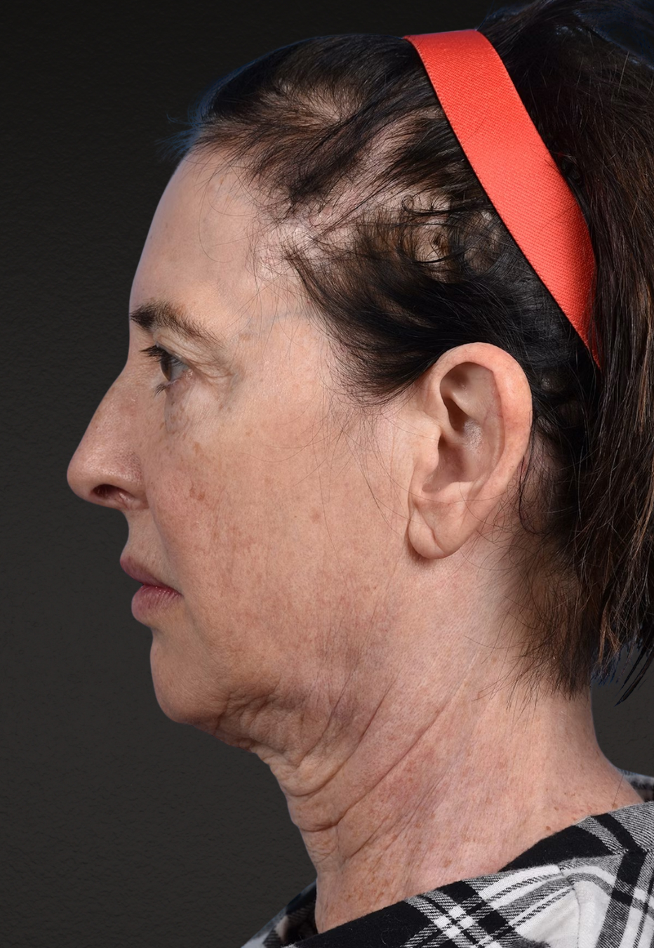 Brow Lift Before & After Gallery - Patient 488051 - Image 7