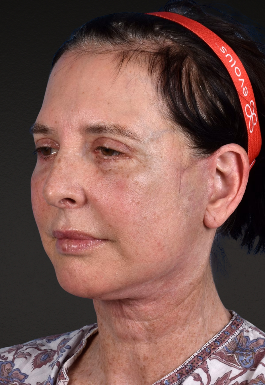 Brow Lift Before & After Gallery - Patient 488051 - Image 10