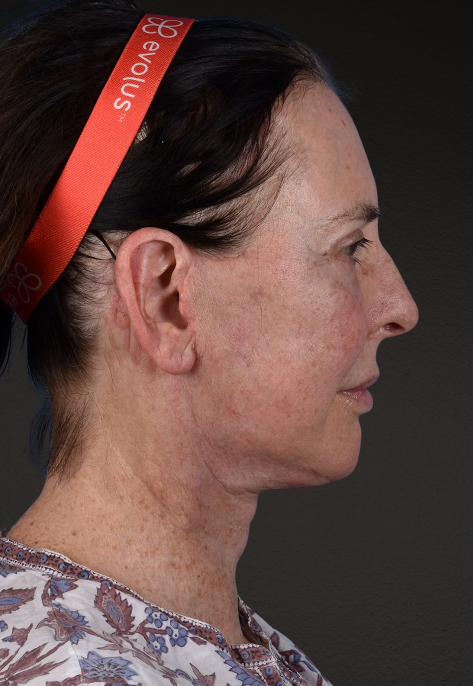 Brow Lift Before & After Gallery - Patient 488051 - Image 6