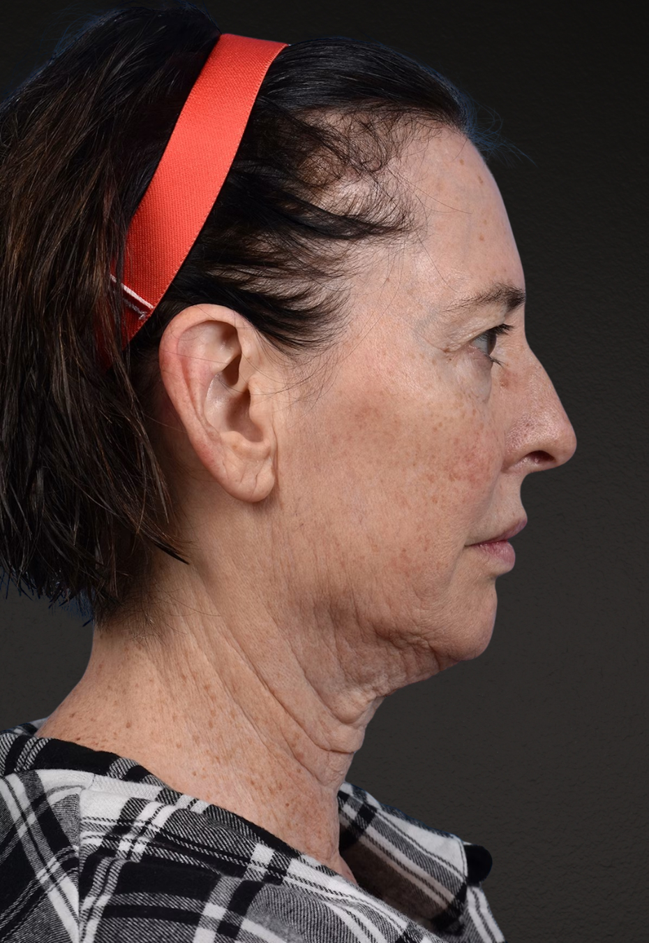 Brow Lift Before & After Gallery - Patient 488051 - Image 5