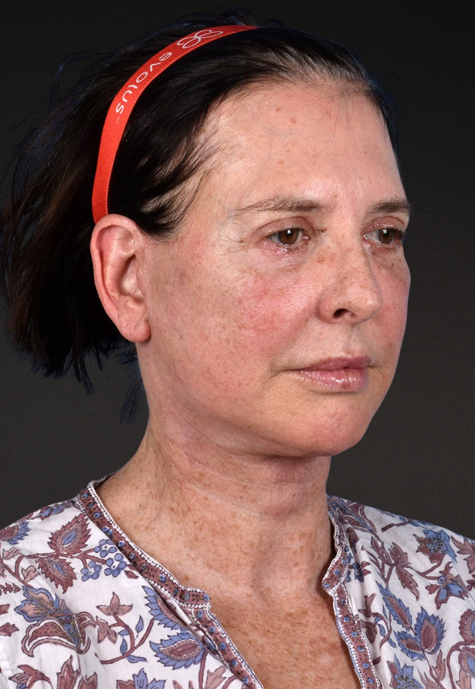 Brow Lift Before & After Gallery - Patient 488051 - Image 4