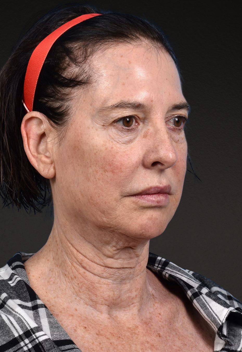 Brow Lift Before & After Gallery - Patient 488051 - Image 3