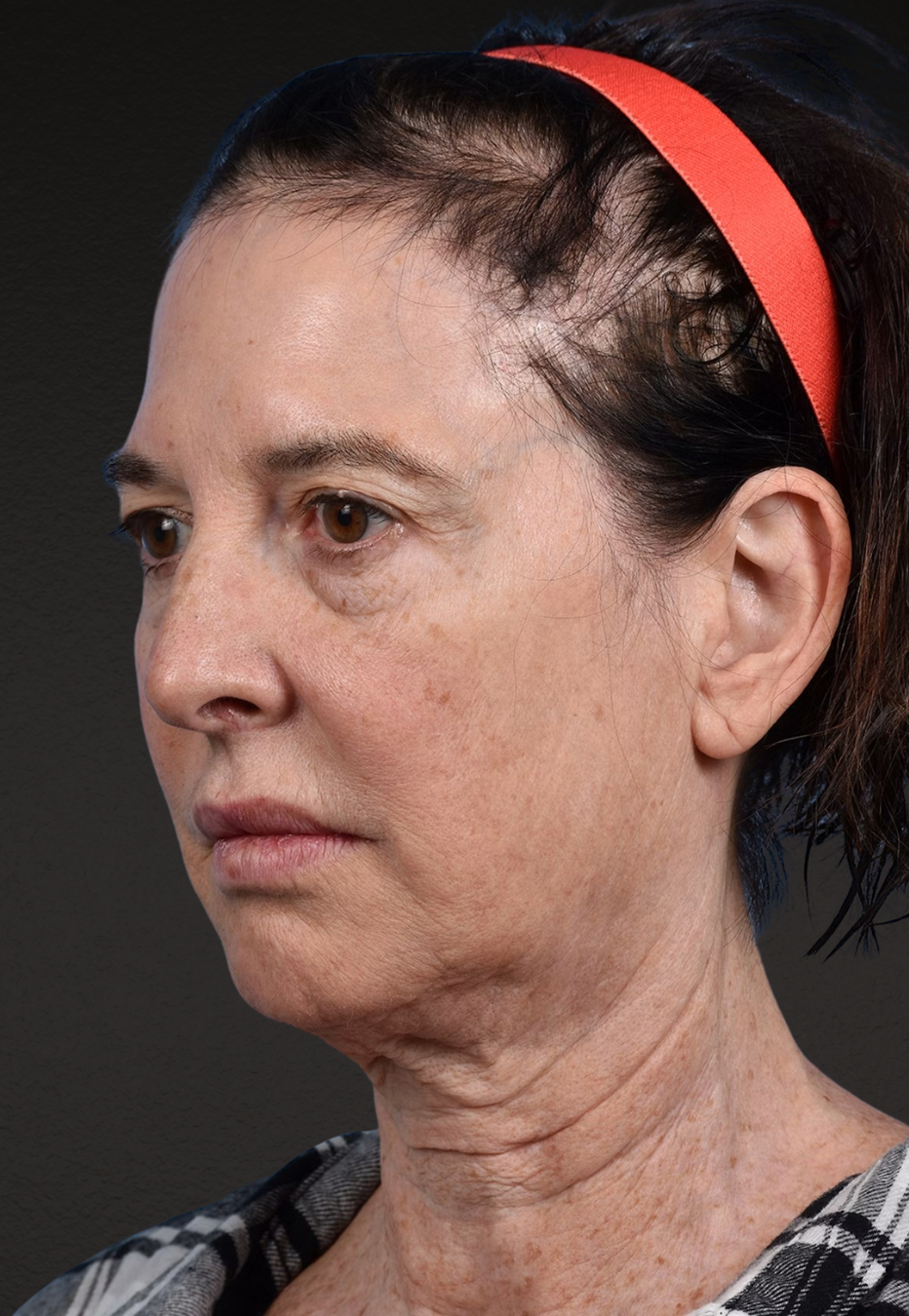 Brow Lift Before & After Gallery - Patient 488051 - Image 9