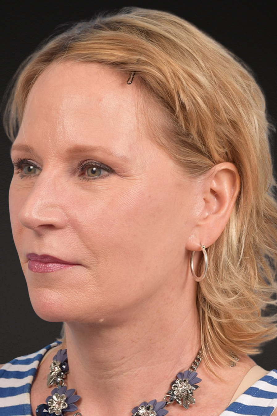 Brow Lift Before & After Gallery - Patient 415432 - Image 8