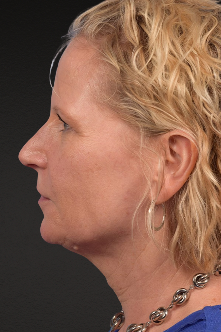 Brow Lift Before & After Gallery - Patient 415432 - Image 9