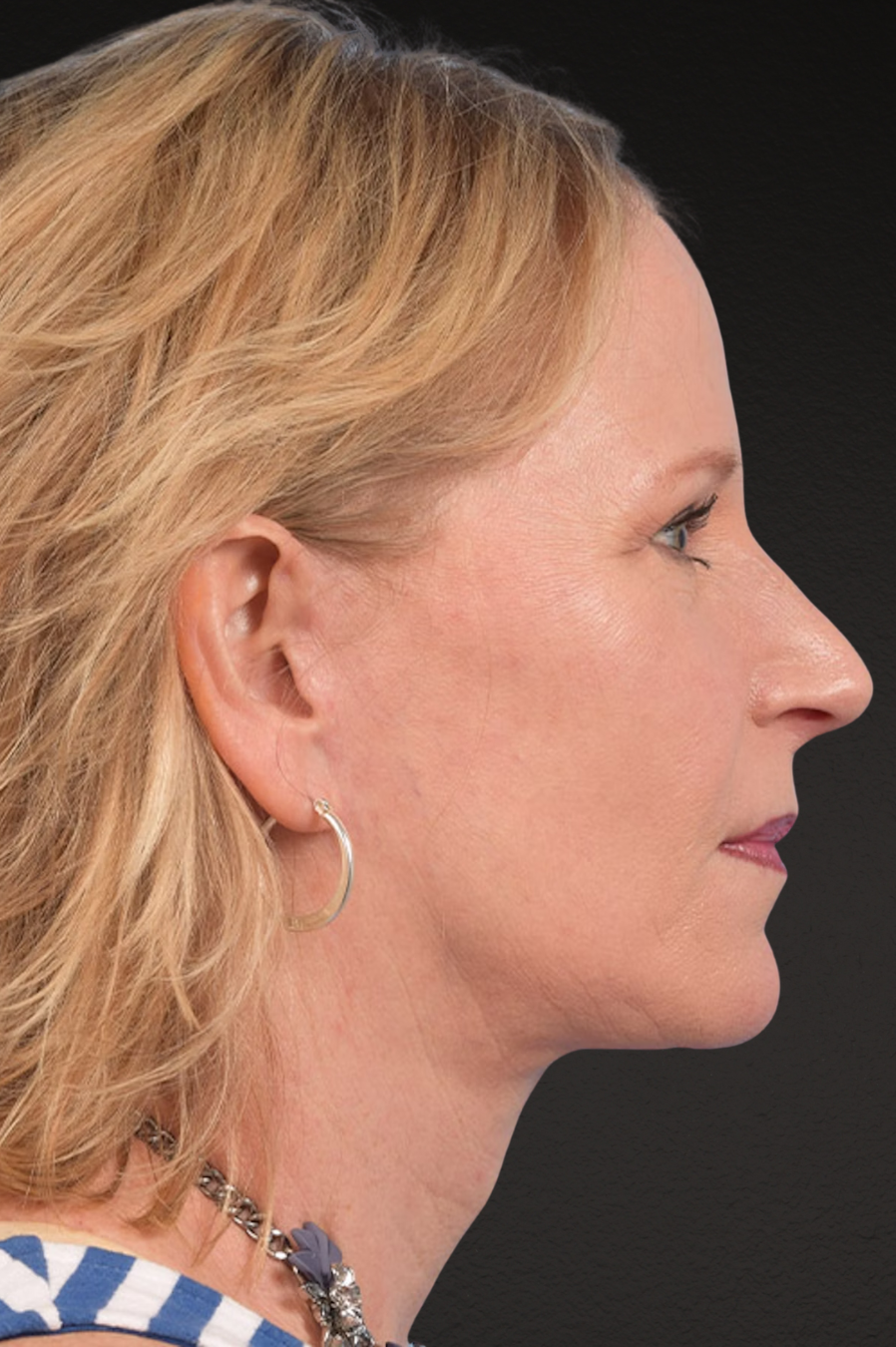 Brow Lift Before & After Gallery - Patient 415432 - Image 6