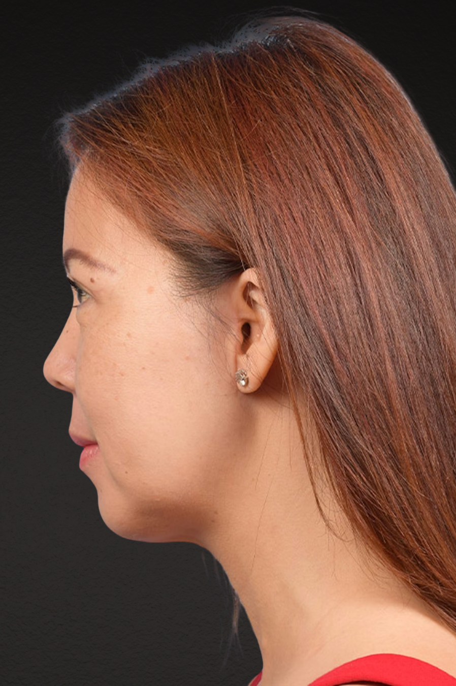 Chin Augmentation Before & After Gallery - Patient 163562 - Image 4