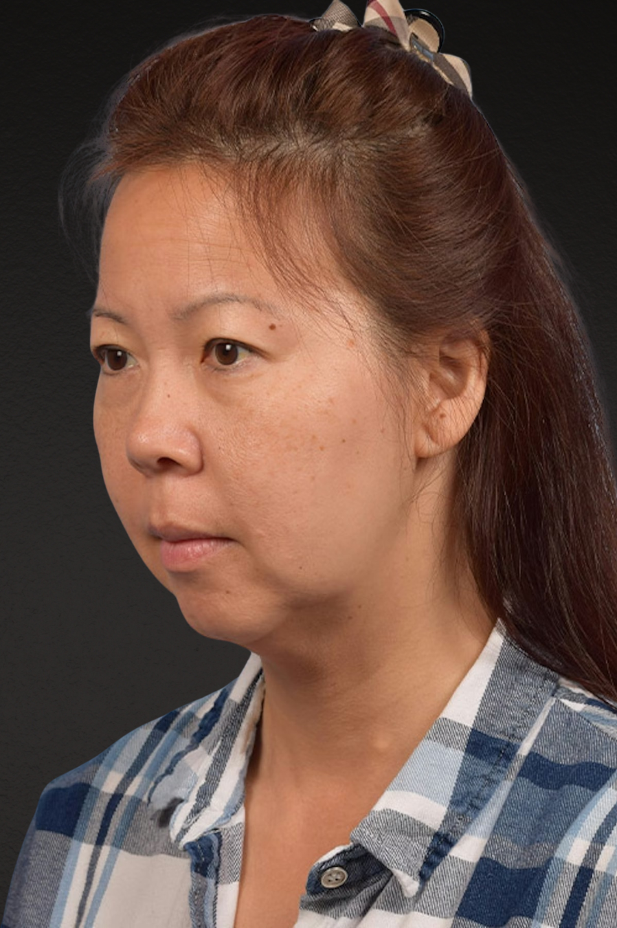 Chin Augmentation Before & After Gallery - Patient 163562 - Image 1