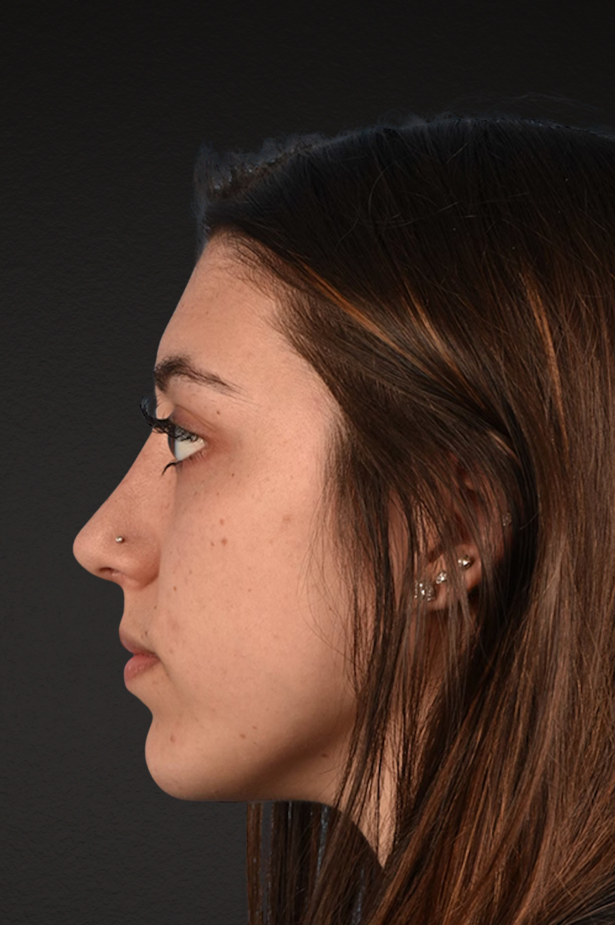 Chin Augmentation Before & After Gallery - Patient 290451 - Image 4