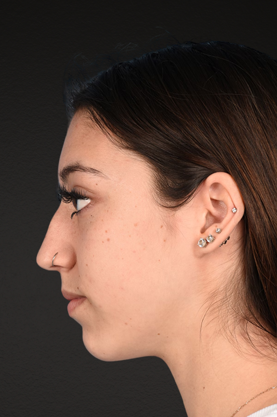 Chin Augmentation Before & After Gallery - Patient 290451 - Image 3