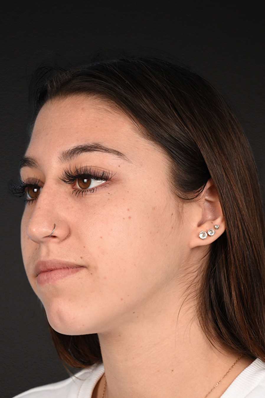 Chin Augmentation Before & After Gallery - Patient 290451 - Image 1