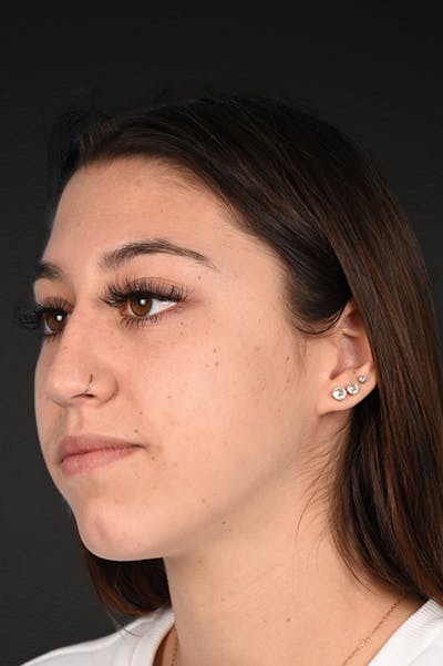 Chin Augmentation Before & After Gallery - Patient 290451 - Image 1