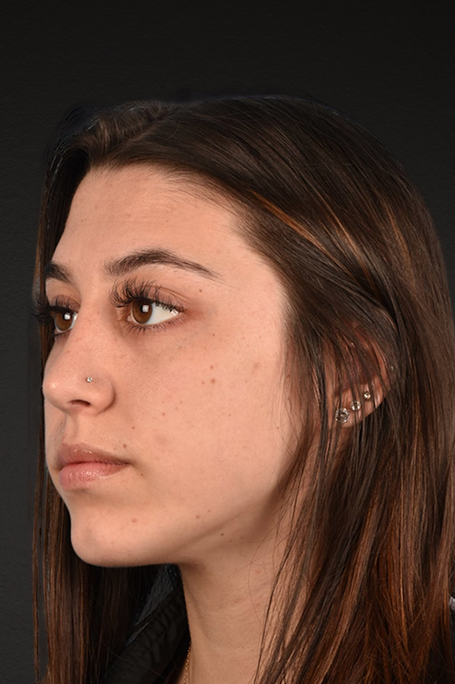 Chin Augmentation Before & After Gallery - Patient 290451 - Image 2