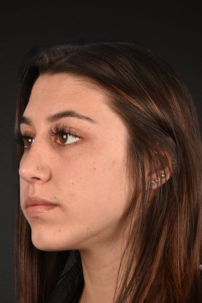 Chin Augmentation Before & After Gallery - Patient 290451 - Image 2