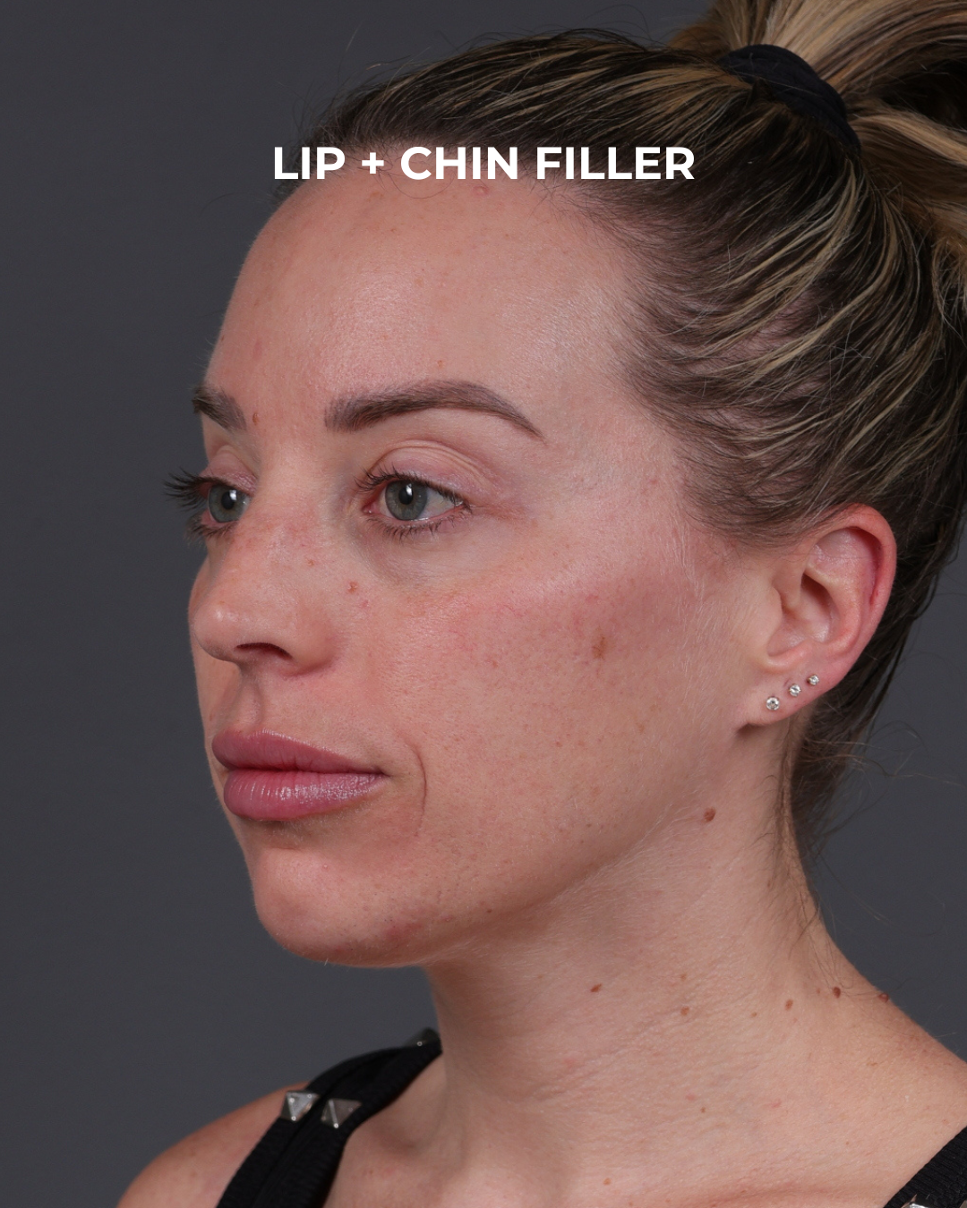 Dermal Fillers Before & After Gallery - Patient 916688 - Image 8