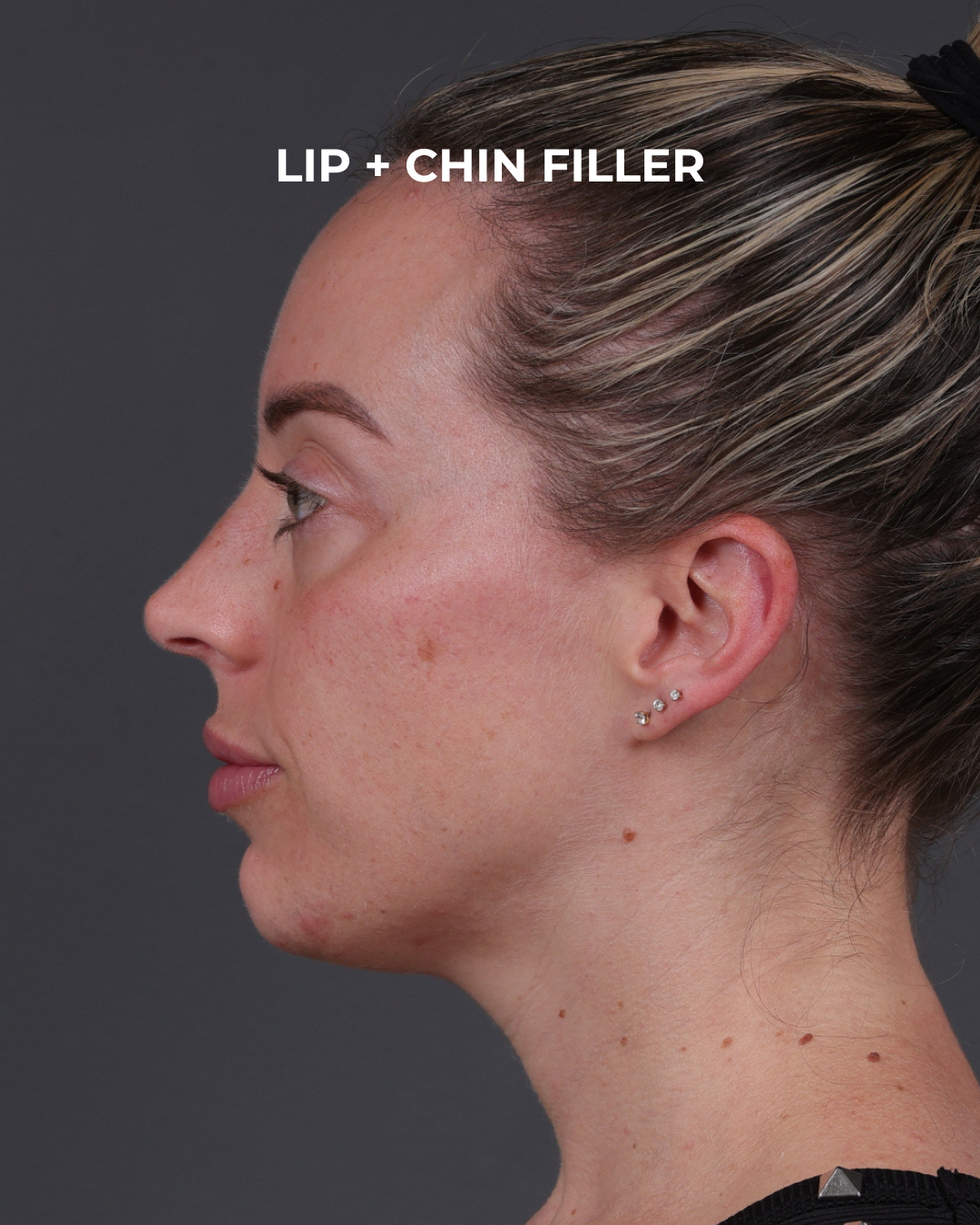 Dermal Fillers Before & After Gallery - Patient 916688 - Image 10