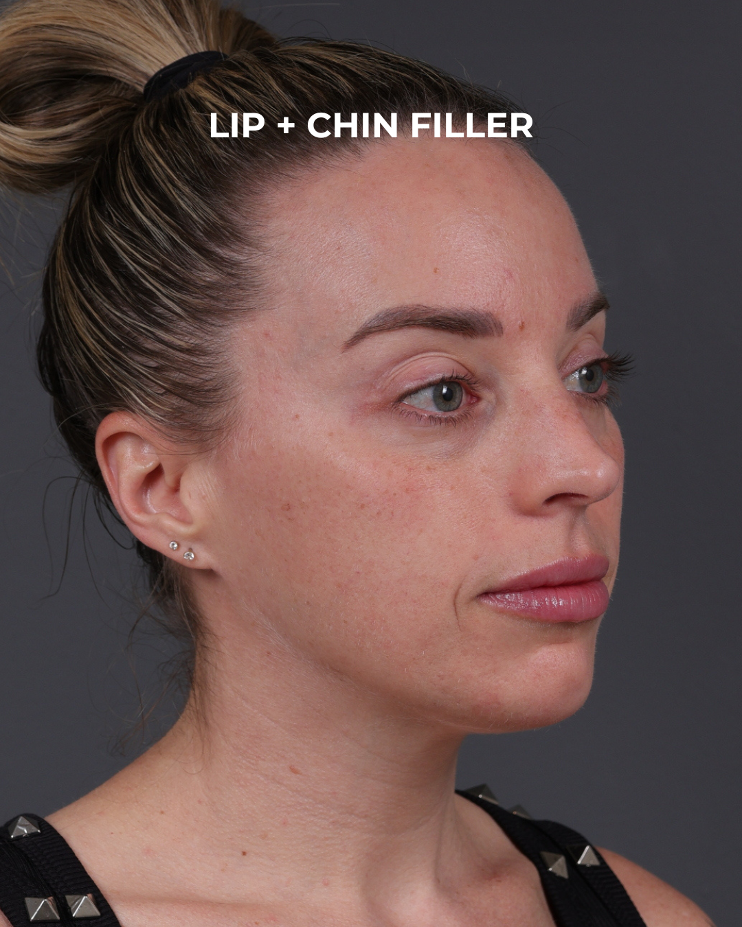 Dermal Fillers Before & After Gallery - Patient 916688 - Image 4